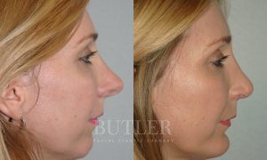 Revision Rhinoplasty Before and After Patient Thumbnail 4