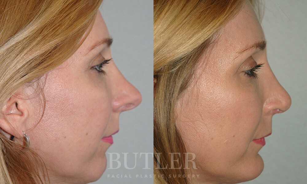 Revision Rhinoplasty Before and After Patient 4