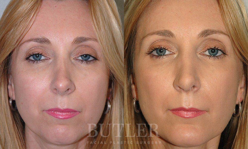 Revision Rhinoplasty Before and After Patient 1