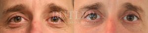 Blepharoplasty Before and After Patient Thumbnail 1