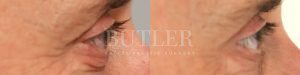 Blepharoplasty Before and After Patient Thumbnail 2