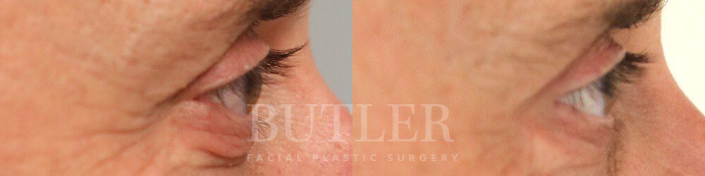 Blepharoplasty Before and After Patient 2