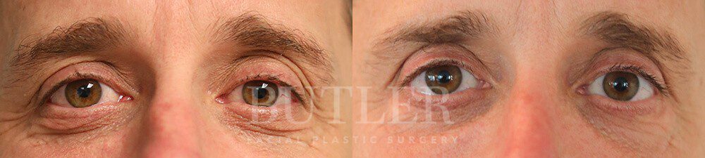 Blepharoplasty Before and After Patient 1