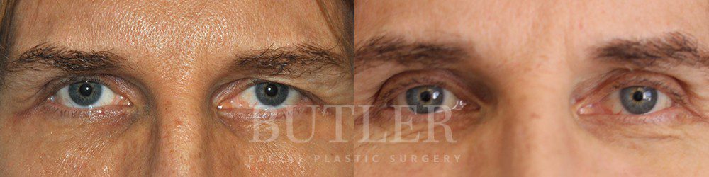Cosmetic & Reconstructive Before and After Patient 9