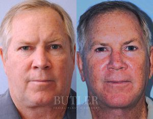 Facelift Before and After Patient Thumbnail 1