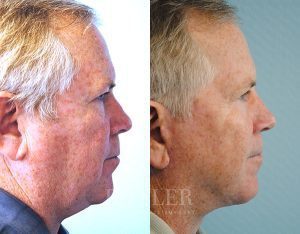 Facelift Before and After Patient Thumbnail 2
