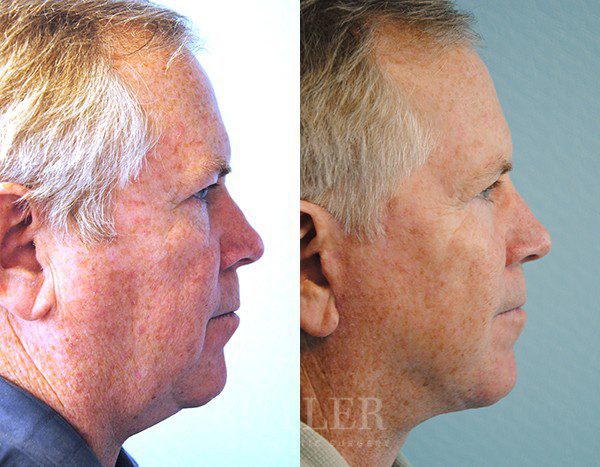 Facelift Before and After Patient 2