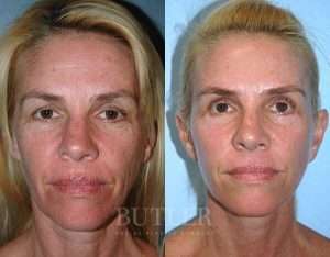 Facelift Before and After Patient Thumbnail 1