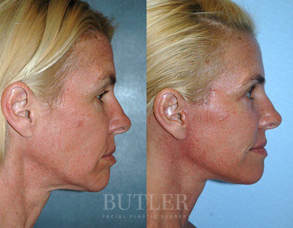 Facelift Before and After Patient 3