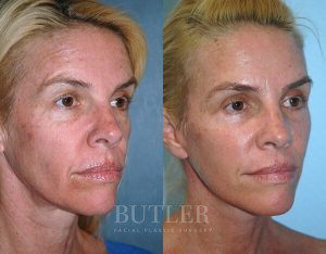Facelift Before and After Patient Thumbnail 2