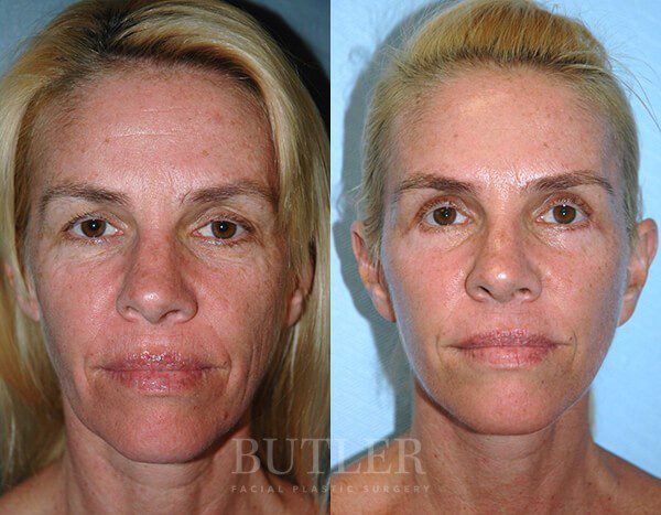 Facelift Before and After Patient 1