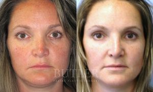 Revision Rhinoplasty Before and After Patient Thumbnail 1