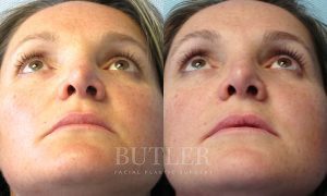 Revision Rhinoplasty Before and After Patient Thumbnail 2