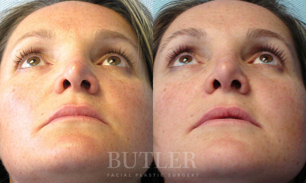 Revision Rhinoplasty Before and After Patient 2