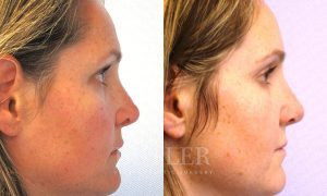 Revision Rhinoplasty Before and After Patient Thumbnail 4