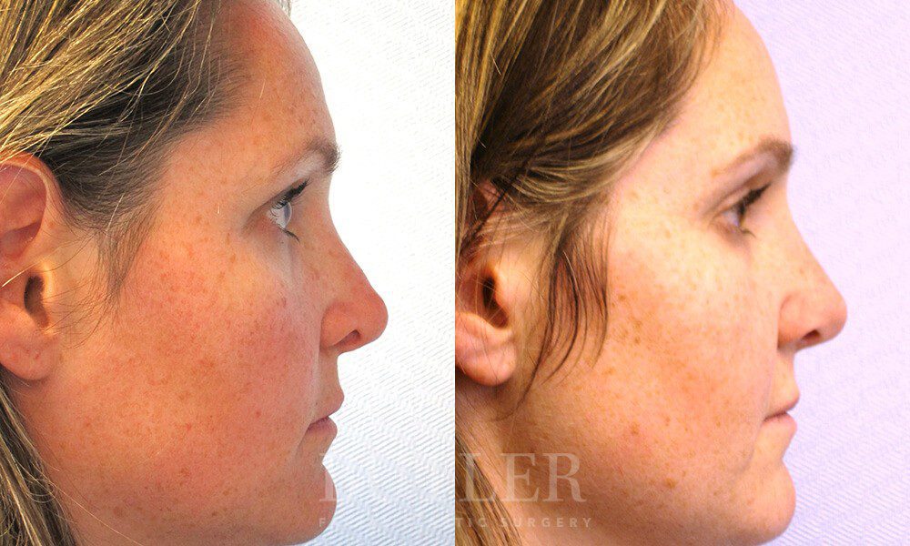 Revision Rhinoplasty Before and After Patient 4