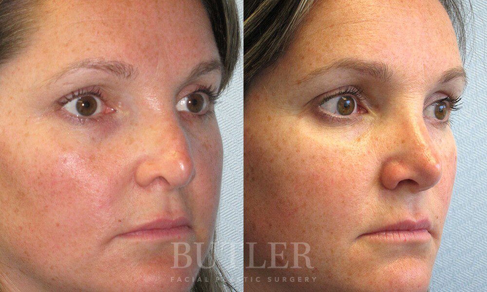 Revision Rhinoplasty Before and After Patient 3