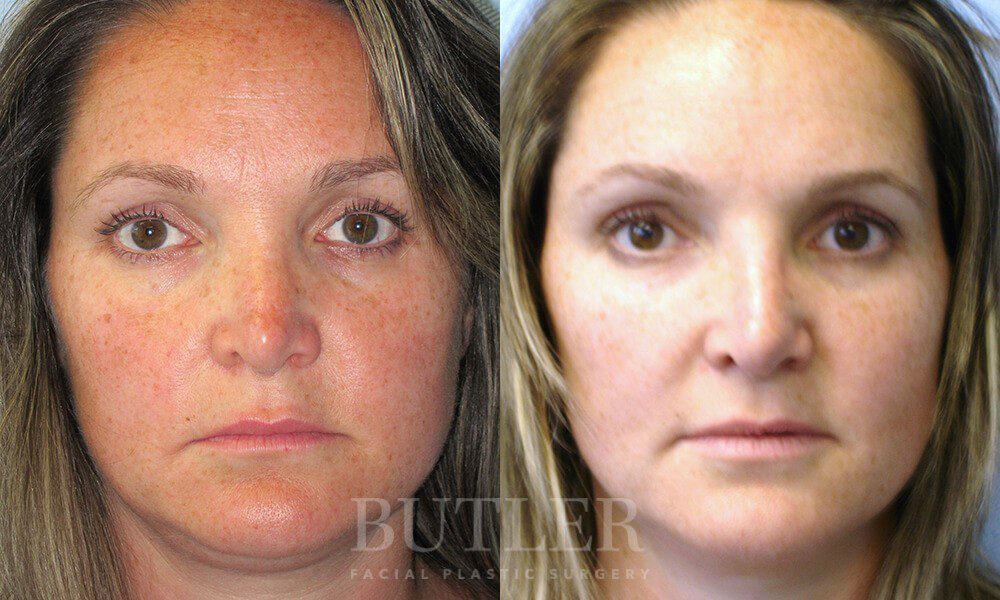 Revision Rhinoplasty Before and After Patient 1