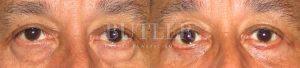 Blepharoplasty Before and After Patient Thumbnail 1