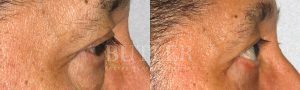 Blepharoplasty Before and After Patient Thumbnail 2