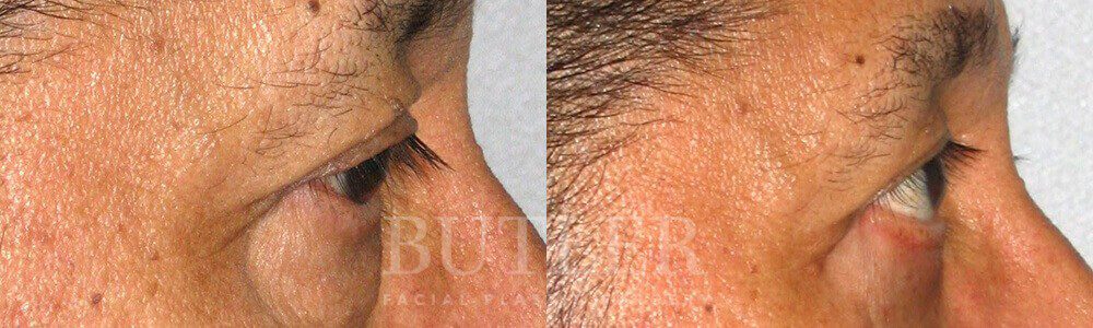 Blepharoplasty Before and After Patient 2