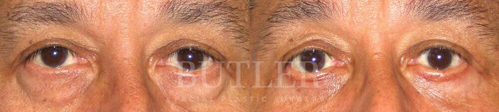 Blepharoplasty Before and After Patient 1