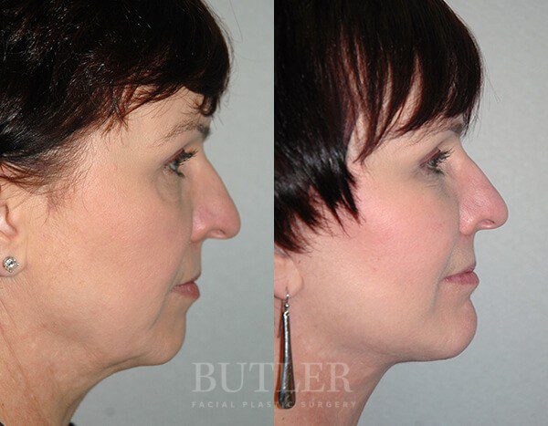 Facelift Before and After Patient 3