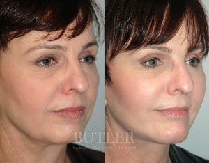 Facelift Before and After Patient Thumbnail 2