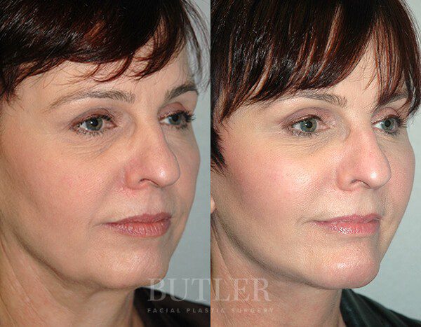 Facelift Before and After Patient 2