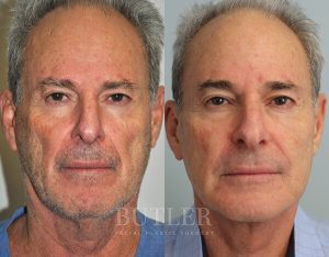 Facelift Before and After Patient Thumbnail 1