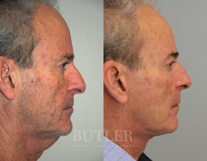 Facelift Before and After Patient Thumbnail 3