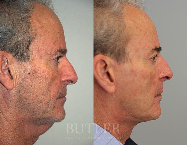 Facelift Before and After Patient 3