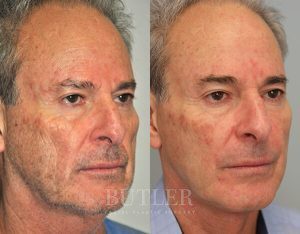Facelift Before and After Patient Thumbnail 2