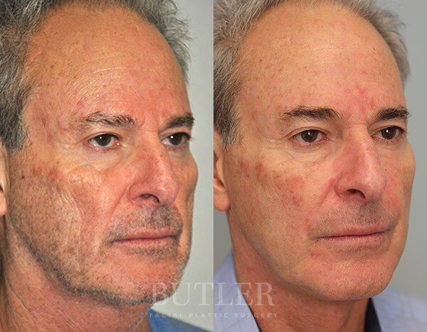 Facelift Before and After Patient 2