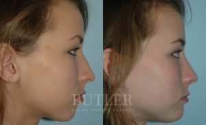 Rhinoplasty Before and After Patient Thumbnail 3