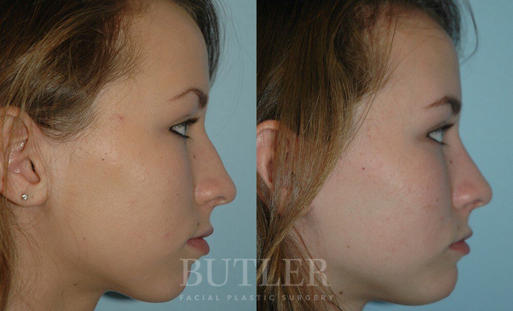 Rhinoplasty Before and After Patient 3