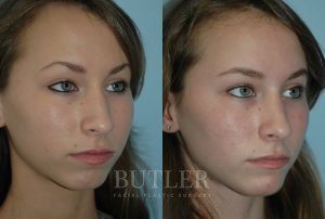 Rhinoplasty Before and After Patient Thumbnail 2