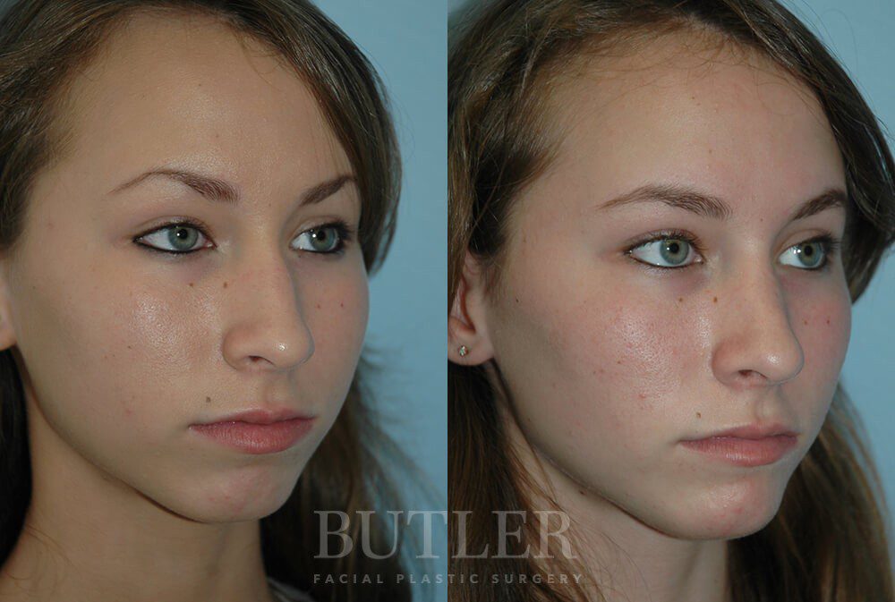 Rhinoplasty Before and After Patient 2