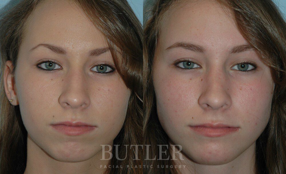 Rhinoplasty Before and After Patient 1
