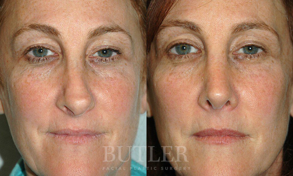 Revision Rhinoplasty Archives - David M. Butler MD Plastic Surgery