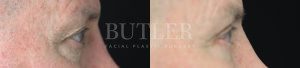 Blepharoplasty Before and After Patient Thumbnail 2