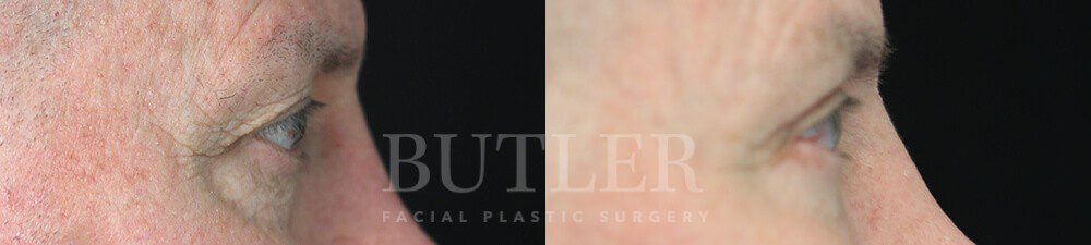 Blepharoplasty Before and After Patient 2