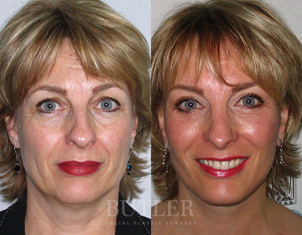 Facelift Before and After Patient 1