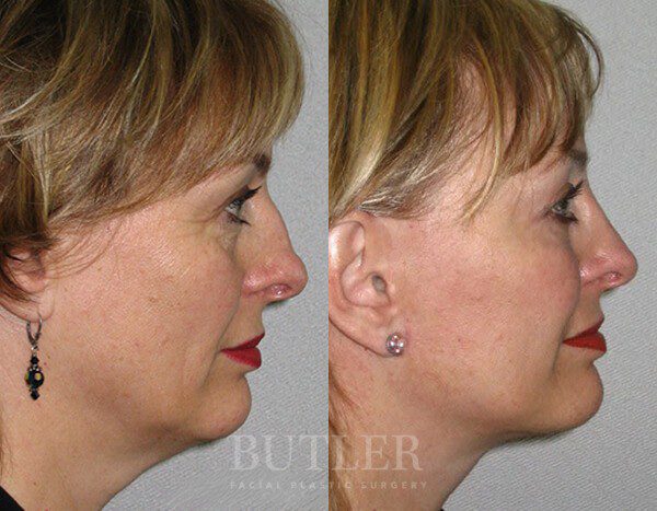 Facelift Before and After Patient 2