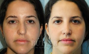 Rhinoplasty Before and After Patient Thumbnail 1