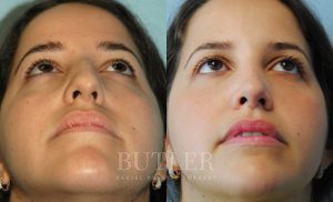 Rhinoplasty Before and After Patient Thumbnail 2
