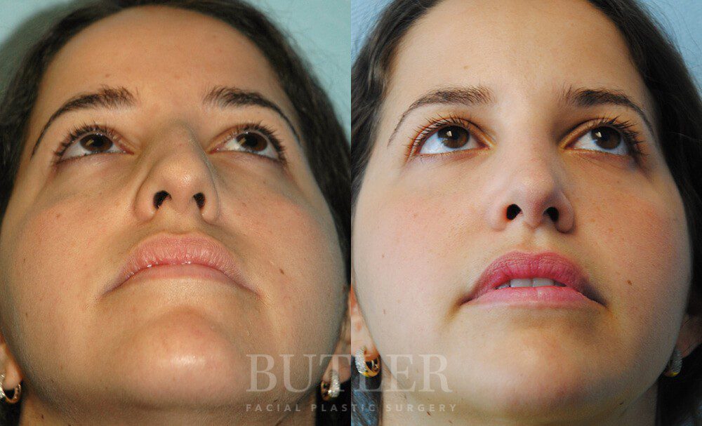 Rhinoplasty Before and After Patient 2