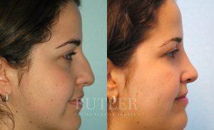 Rhinoplasty Before and After Patient Thumbnail 4