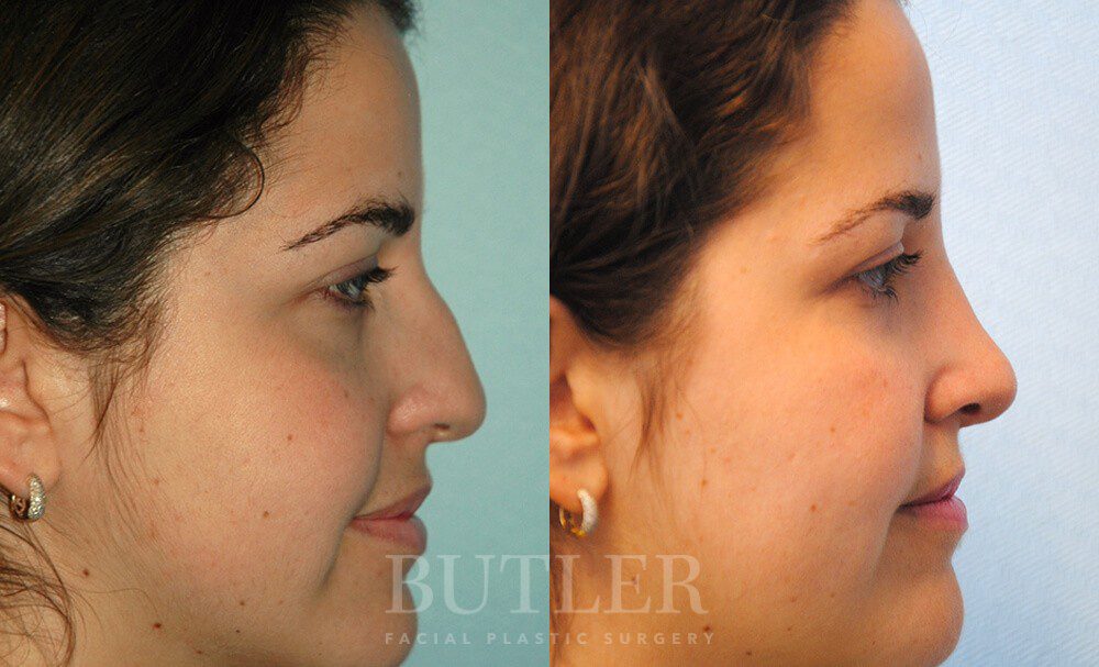 Rhinoplasty Before and After Patient 4