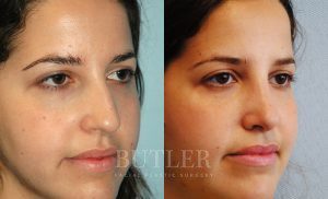 Rhinoplasty Before and After Patient Thumbnail 3